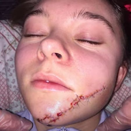 Taylor Hickson is resting as there is a huge stitches on the face scar.